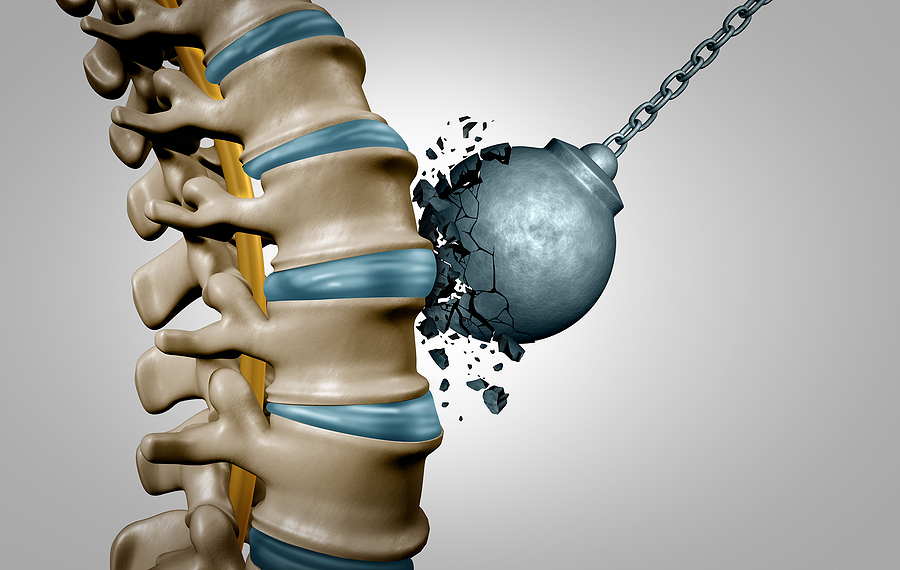 Erfahren Sie, wie Sie mit chiropraktischen Techniken richtig heben, um Rückenverletzungen vorzubeugen. Schützen Sie Ihren Rücken mit unseren wirksamen Methoden und steigern Sie Ihr Wohlbefinden und Ihre Produktivität. 